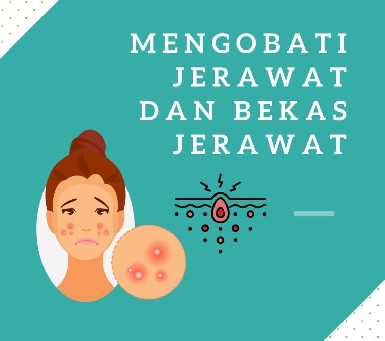 Mengobati Jerawat dan Bekas Jerawat